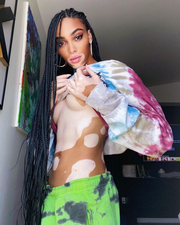 Winnie Harlow Sexy After Two Months Of Self-Isolation (6 Photos)